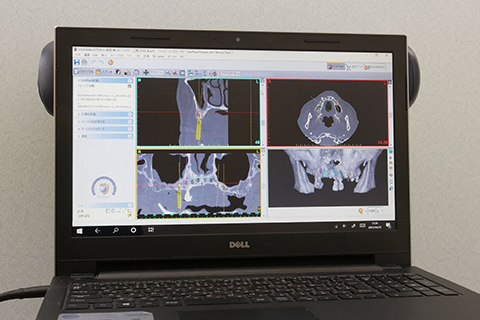 3D（simplant）CT分析用モニター
